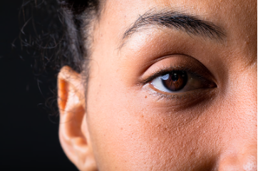Under-eye puffiness from minoxidil